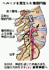 ヘルニア